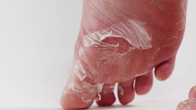 Close-up of man's foot standing on tiptoes, showing severe peeling of the dry skin of the foot. Effect of skin renewal with acidic pedicure cosmetics. Close-up, white background