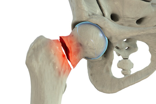 Displaced femoral neck fracture, 3D illustration.