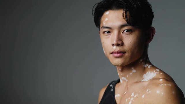 Young Asian man with vitiligo skin condition looking at camera against grey background medium shot