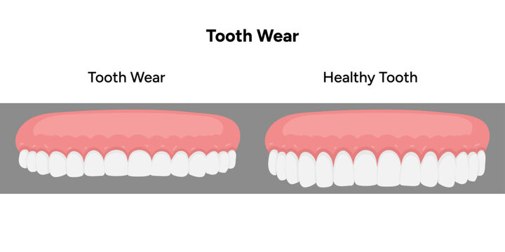 Hand-drawn illustration of tooth wear dental and medical style. Detailed composition gradual enamel loss, flattened tooth surfaces, and structural changes. Educational visual designed