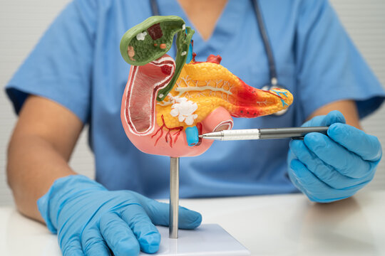 Pancreatitis, pancreatic cancer, Asian doctor with pancreas, gallbladder and bile duct human anatomy model at hospital.