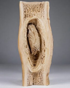 Chronic Osteomyelitis with Sequestrum in Bone Cross Section