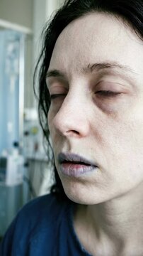 Patient experiencing severe iron deficiency anemia, displaying extreme pallor, dark circles under eyes, and cyanosis in a hospital setting, medical health condition