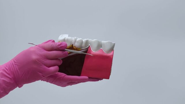 Dentist in Pink Gloves Pointing at Periodontal Disease and Tartar on Teeth Model