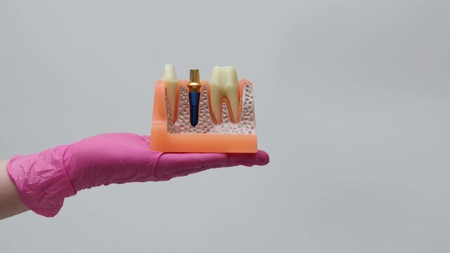 Dental bridge placement on implant and natural teeth anatomical model