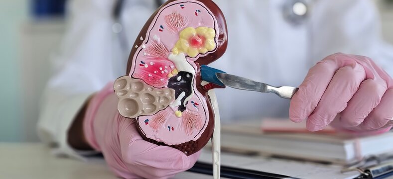 Kidney and adrenal surgery is a medical surgical operation. The doctor holds the kidneys with the ureter,