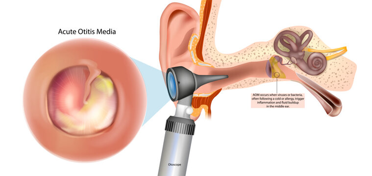 Acute Otitis Media Medical Illustration with Otoscope Ear Examination and Middle Ear Infection Anatomy. Acute Otitis Media Anatomy Infographic with Eardrum Inflammation Fluid and Inner Ear Structure