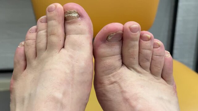 Man feet with discolored toenail closeup, sitting in yellow clinic armchair before nail plate debridement, visible surgical scars
