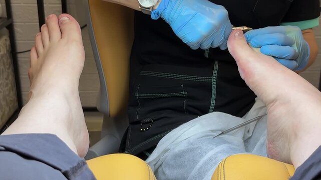 Podiatrist treating toenail fungus with drill, clinic chair patient with infected nail, clinician wearing blue gloves uses diamond