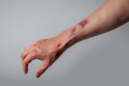 Close-up of a human arm showing visible scars and skin discoloration after infection, isolated on a clean background, highlighting healing, medical conditions, and dermatological concerns