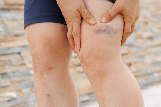People show the bruised legs