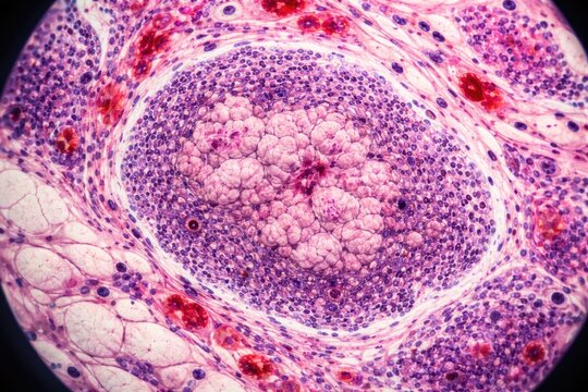 Close up microscopic examination of granulomatous mastitis within breast tissue sections