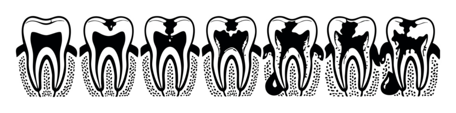 Tooth decay progression illustration showing enamel erosion, dentin damage, pulp infection, and abscess formation in a molar