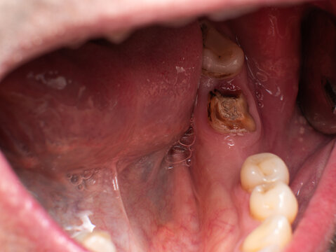 Lower second molar almost reduced to the gum, adjacent to a missing first molar and a poor third molar