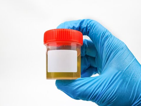 Gloved hand holding a sterile urine sample container isolated on white background