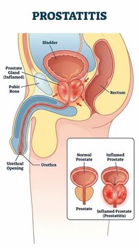 Male anatomy condition: prostate gland, inflammatory state, normal morphology, zonal structure, pelvic organ, urethra bladder, clinical visualize, pathological atlas.