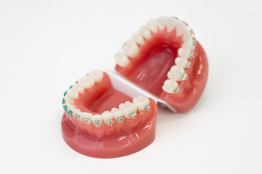 Dental phantom showing brackets and archwire for teaching orthodontists the installation procedure and maintenance of teeth alignment systems in medical school or workshop laboratory.