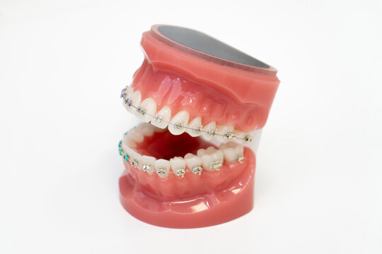 Dental jaw phantom with metal brackets used for medical website marketing or clinic advertisement to show modern teeth correction technology and professional orthodontics services.