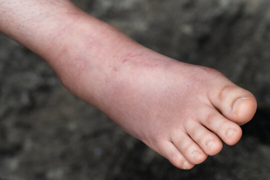 Swollen Foot After Cast Removal of Metatarsal Fracture