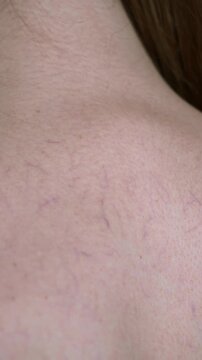 Close up view of a young woman back skin with visible spider veins and capillaries. Natural skin texture and detail, dermatology and skincare concept. Neutral indoor lighting, real unretouched skin.