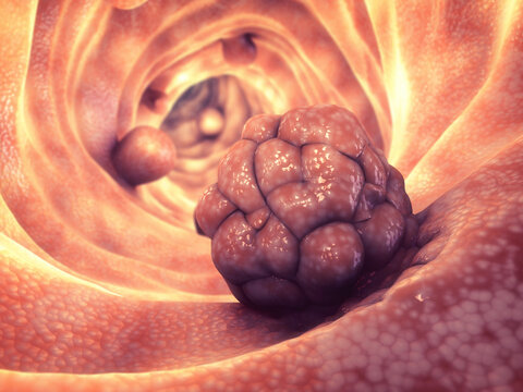 Abnormal cell clusters on the mucosal lining of the large intestine. Most polyps stay harmless, yet others progress from benign states to invasive tumors.