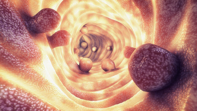 Colorectal polyps. These growths form on the bowel lining and range from benign clusters to dangerous, precancerous malignancies