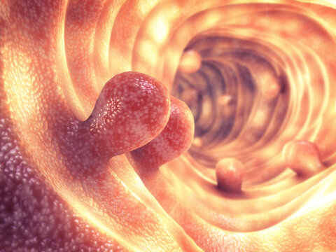 Benign tissue growths along the intestinal wall. While many bowel polyps are harmless, specific clusters can mutate and develop into malignant colon cancer.