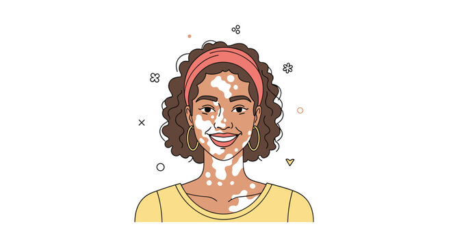 A smiling young woman with distinct vitiligo patterns on her face and neck wears a pink headband and large hoop earrings in this flat digital art portrait design.