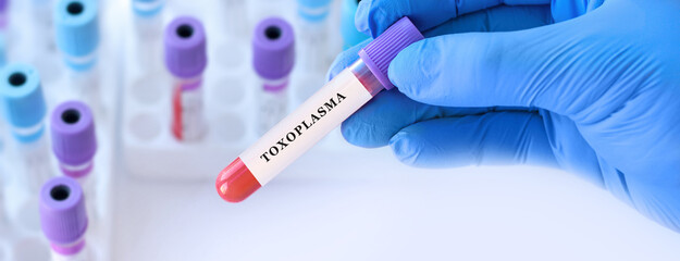 Doctor holding blood sample tube with toxoplasma test in medical laboratory, infectious disease...