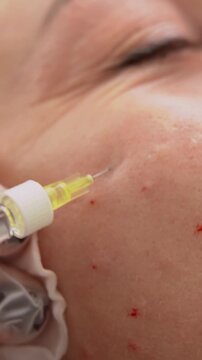Vertical frame close up of medical needle injection on female face with visible papules for skin hydration and professional rejuvenation treatment in aesthetic clinic using mesotherapy technique