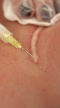 Vertical frame macro shot of medical needle injection into hypertrophic scar or keloid for tissue softening and reduction professional dermatological treatment in aesthetic medical clinic