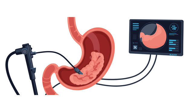 Medical illustration of an internal endoscopy procedure showing a camera probe inside the stomach with a digital monitor.
