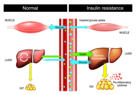 Insulin resistance. Insulin and Glucose Balance. Liver, Muscles and hyperinsulinemia.