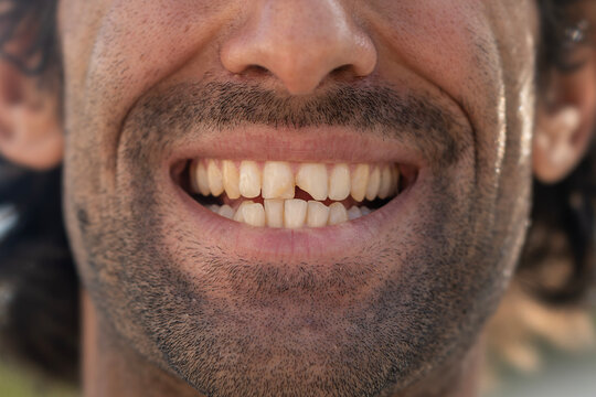 close up of a man with a beard and smile with a broken front tooth incisors