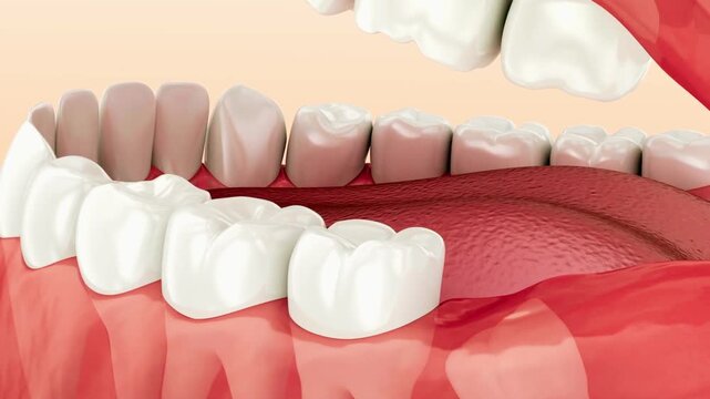Medically accurate 3D animation showing wisdom tooth problems including impaction, gum inflammation, and crowding, illustrating dental complications and oral surgery concepts.