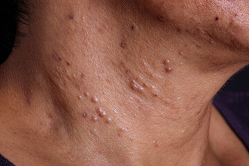 Naklejka premium Acne skin neck macro closeup dermatology blemish pimple texture health medical adult problem inflamed irritated spot scar epidermis complexion care human face detail imperfection unhealthy disease