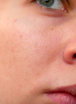 close up of a caucasian young woman's skin showing pores and blemishes 