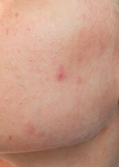 Fototapeta premium close up of a caucasian young woman's skin showing pores and blemishes 