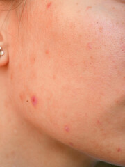 Fototapeta premium close up of a caucasian young woman's skin showing pores and blemishes 