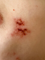 Fototapeta premium Close-Up of Herpes Zoster Rash on Skin – Shingles Dermatology Medical Condition
