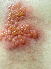 Fototapeta premium Close-Up of Herpes Zoster Rash on Skin – Shingles Dermatology Medical Condition