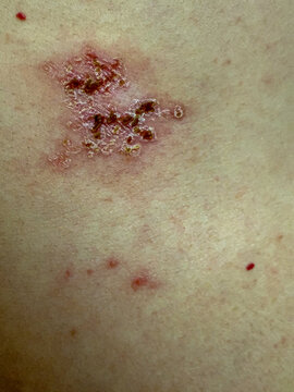 Close-Up of Herpes Zoster Rash on Skin &ndash; Shingles Dermatology Medical Condition