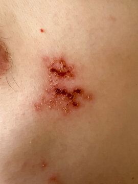 Close-Up of Herpes Zoster Rash on Skin &ndash; Shingles Dermatology Medical Condition