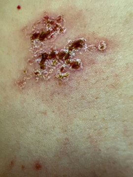 Close-Up of Herpes Zoster Rash on Skin &ndash; Shingles Dermatology Medical Condition