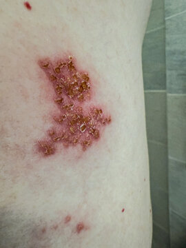 Close-Up of Herpes Zoster Rash on Skin &ndash; Shingles Dermatology Medical Condition