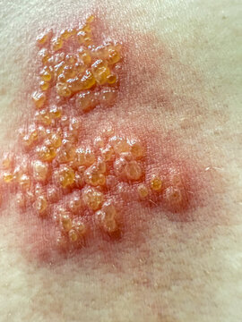 Close-Up of Herpes Zoster Rash on Skin &ndash; Shingles Dermatology Medical Condition