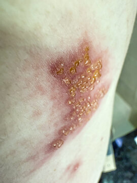 Close-Up of Herpes Zoster Rash on Skin &ndash; Shingles Dermatology Medical Condition