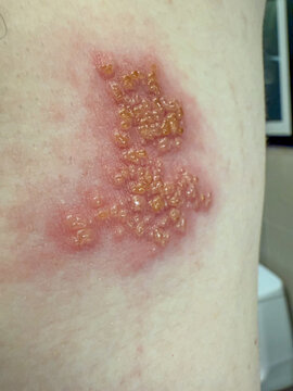 Close-Up of Herpes Zoster Rash on Skin &ndash; Shingles Dermatology Medical Condition