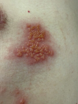 Close-Up of Herpes Zoster Rash on Skin &ndash; Shingles Dermatology Medical Condition