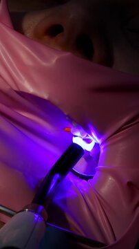 Close-up of dentist using UV curing light to harden composite filling. Modern dental restoration, advanced technology and professional oral care in clinic.